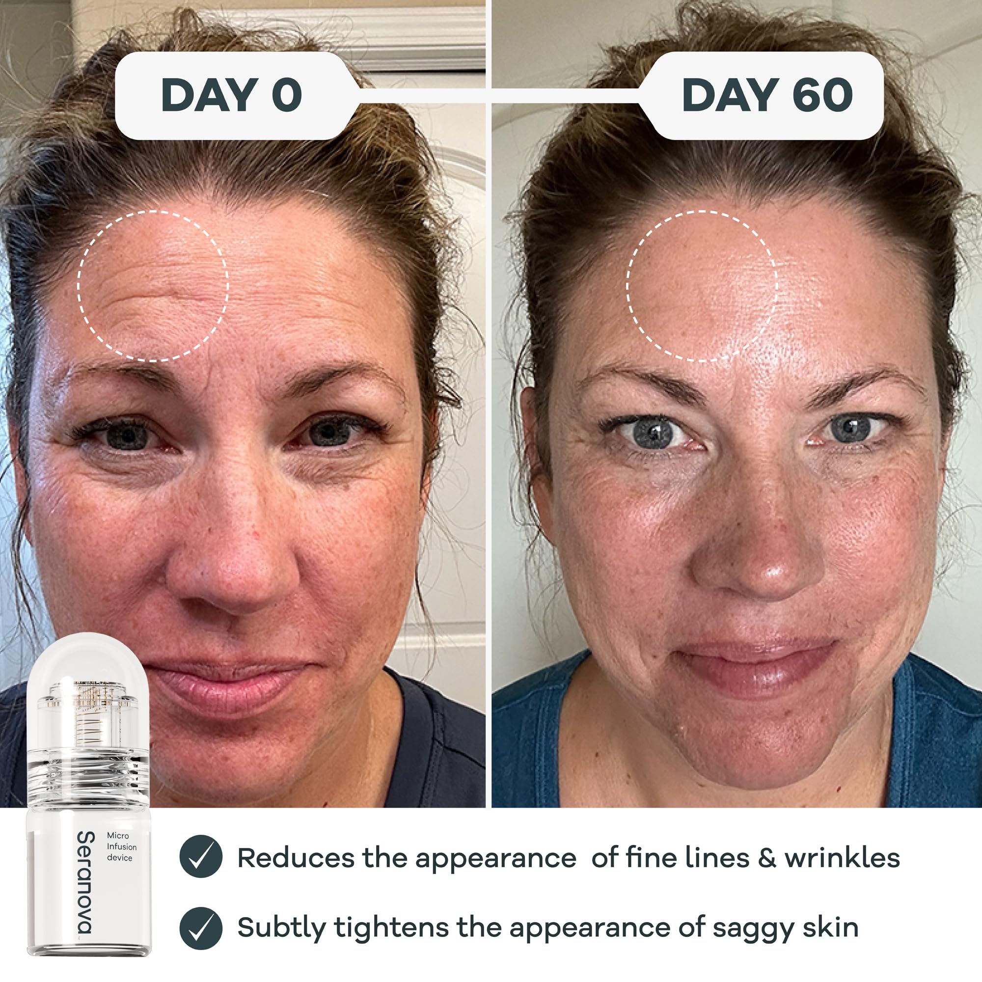 Seranova Micro Infusion Facial Kit – Hydrating Serum & Gentle Skin Care System with Hyaluronic Acid & Peptides, 1-Month Supply